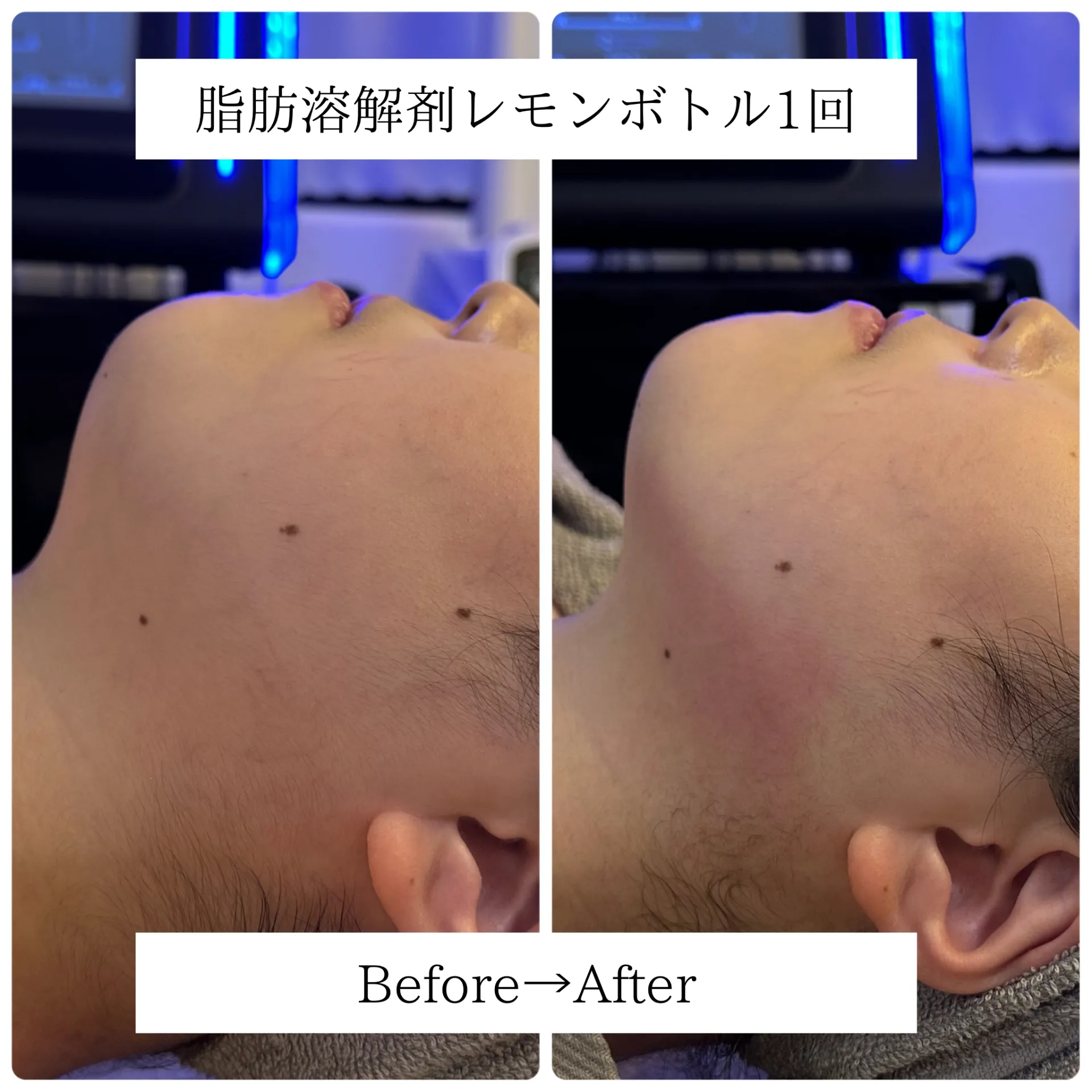 レモンボトル1回 あご下